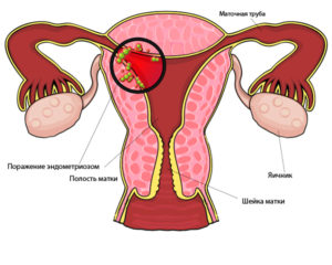 эндометриоз матки схема