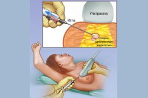 Фиброаденома молочной железы в период менопаузы thumbnail
