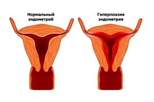 разрастание слизистой половых органов женщины