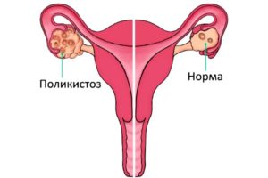 разрастание фолликулов в женском репродуктивном органе