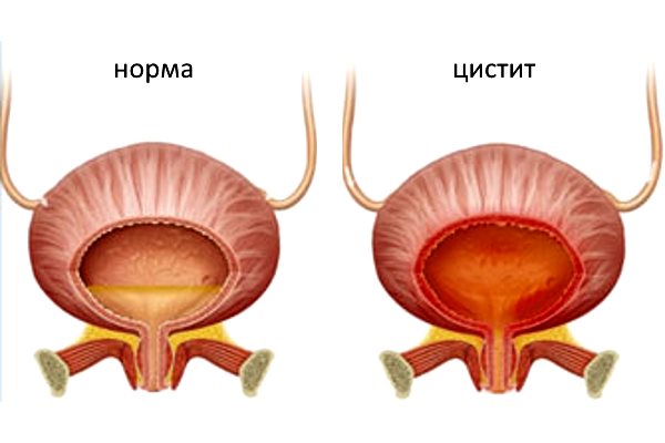 Менопауза и цистит: мочевой пузырь при климаксе у женщин
