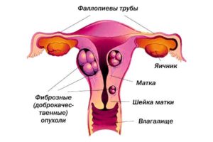 опухоль в детородных органах женщины 