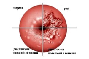 Рак эндометрия в период менопаузы