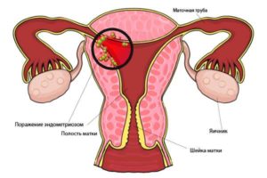 Эндометриоз матки в период менопаузы симптомы и лечение