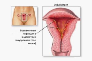 Хронический эндометрит в менопаузе лечение