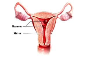 Лечение после удаления полипа эндометрия в матке в менопаузе