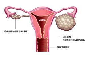 После менопаузы может быть рак яичников