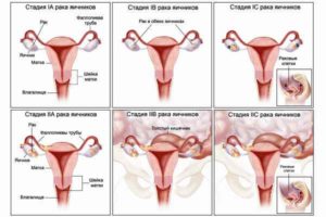 стадии онкологии в женских репродуктивных органах
