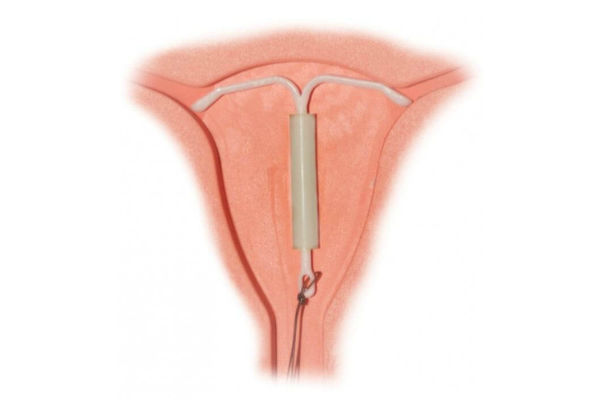 внутриматочные контрацептивы
