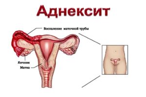 Воспаление придатков симптомы при климаксе у женщин и его лечение
